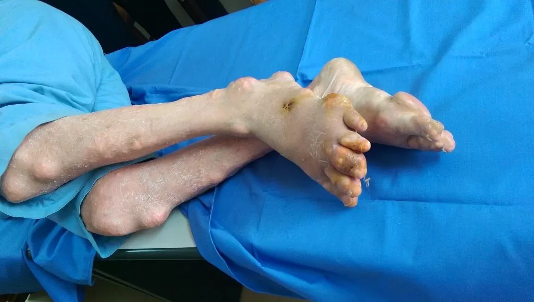 Giai đoạn gút mạn tính xuất hiện các hạt tophi