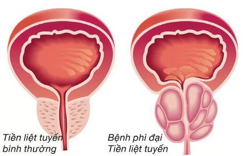Nguyên nhân gây u xơ tiền liệt tuyến là gì?