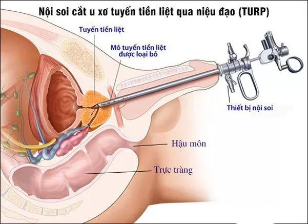 Phương pháp nội soi cắt u xơ tuyến tiền liệt