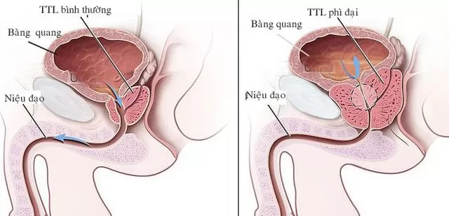 Hỏi: Dùng BoniMen có kh_ỏi được bệnh phì đại tuyến tiền liệt hay không?