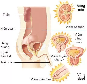 Tổng quan về viêm đường tiết niệu