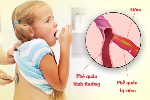 Phòng ngừa viêm phế quản ở trẻ nhỏ thời điểm giao mùa bằng cách nào?