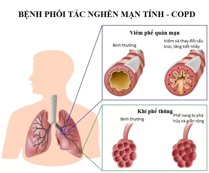 BoniDetox cho hiệu quả vượt trội nhờ cơ chế toàn diện và công nghệ bào chế hiện đại