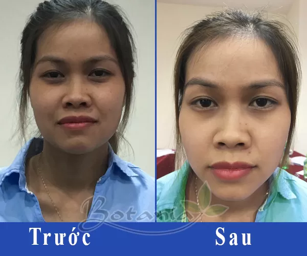 Nhờ BoniSnow, da sáng hồng, đỡ quầng thâm mắt và mụn