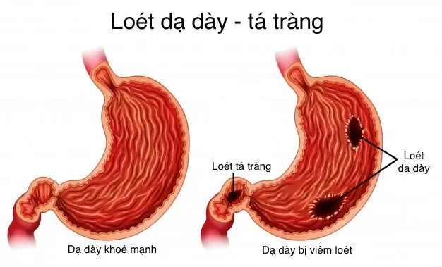 Viêm loét dạ dày có thể gây tình trạng đi ngoài nhiều lần