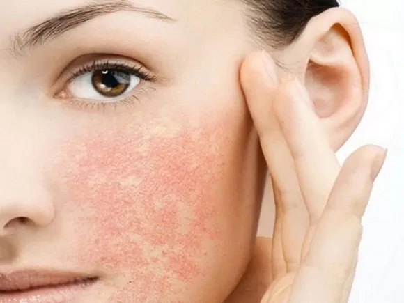 Tìm hiểu về thương tổn da cơ bản thứ phát