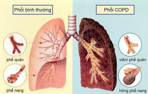 Người thường xuyên hút thuốc lá có nên phòng ngừa bệnh phổi tắc nghẽn mãn tính COPD bằng BoniDetox