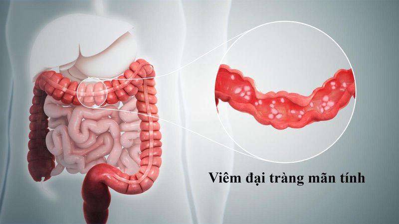 Đi ngoài nhiều lần trong ngày có thể do viêm đại tràng mãn tính