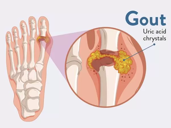 Bệnh gút là gì?