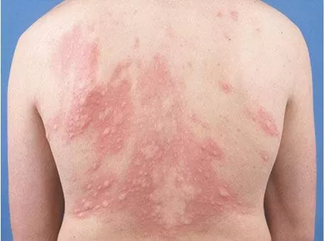 Hội chứng Steven- Johnson do Allopurinol gây ra
