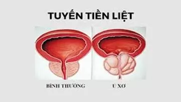 U xơ tuyến tiền liệt
